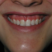 gummy_smile.jpg