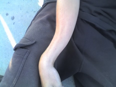 BrokenArm.jpg