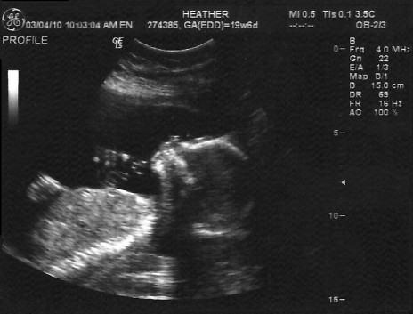 ultrasound20weeks.jpg