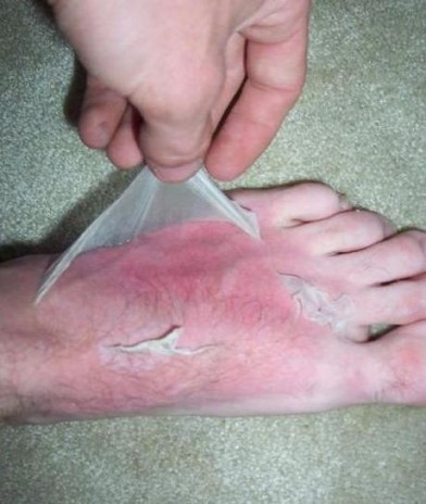 Gross_Foot_Peel.jpg